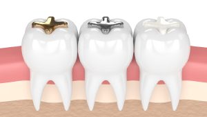 Three molar teeth with different dental fillings: gold on the left, silver (amalgam) in the middle, and white (composite or ceramic) on the right, shown in a row against gum tissue.